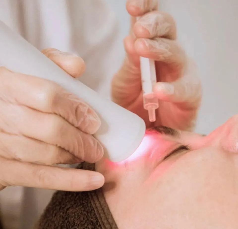 Mesolux en el rostro: el cabezal sobre la piel y el activo en una jeringa sin aguja